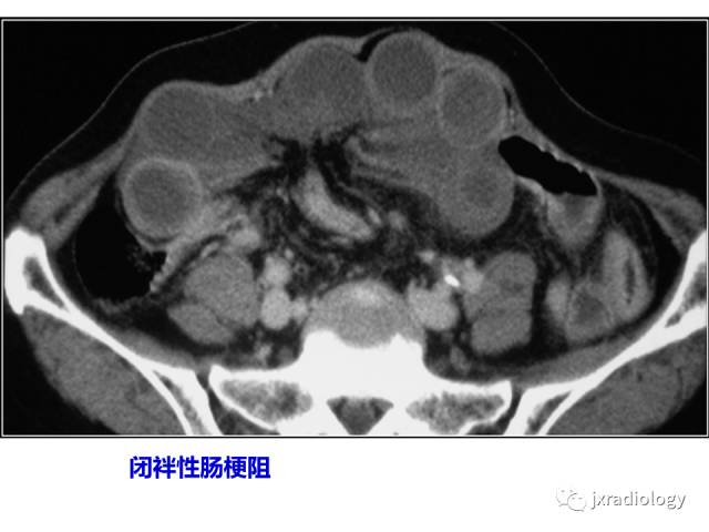 【PPT】肠壁增厚的CT鉴别诊断