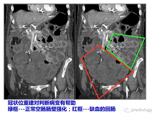 【PPT】肠壁增厚的CT鉴别诊断