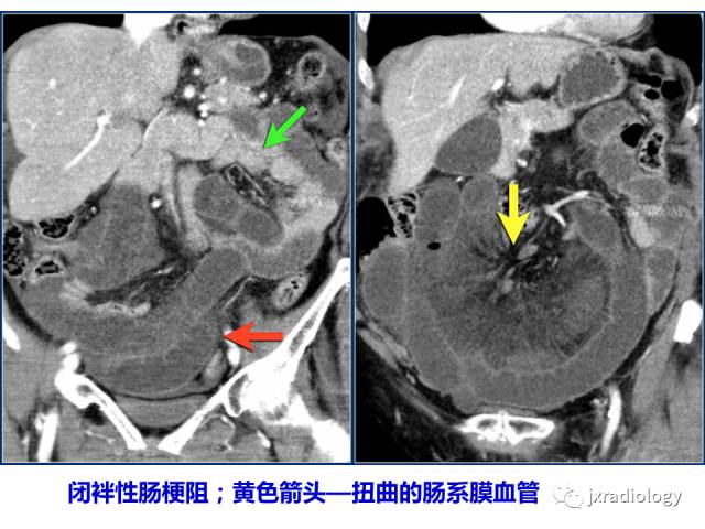 【PPT】肠壁增厚的CT鉴别诊断