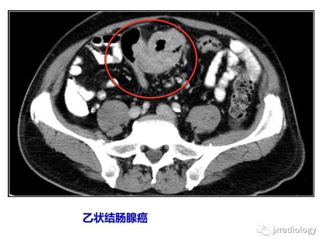 【PPT】肠壁增厚的CT鉴别诊断