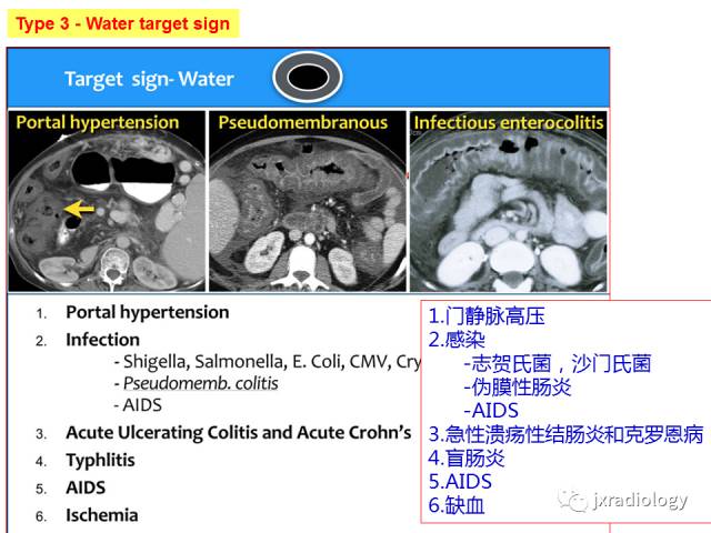 【PPT】肠壁增厚的CT鉴别诊断