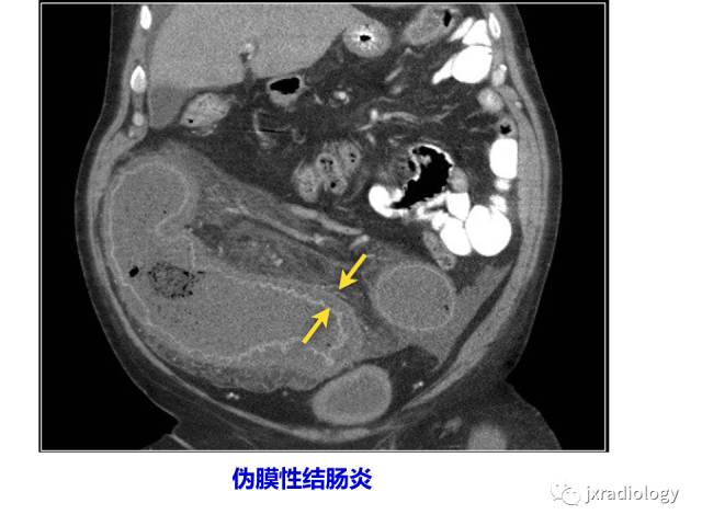 【PPT】肠壁增厚的CT鉴别诊断