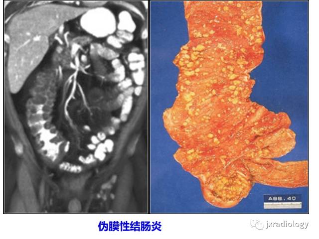 【PPT】肠壁增厚的CT鉴别诊断