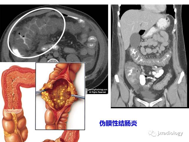 【PPT】肠壁增厚的CT鉴别诊断