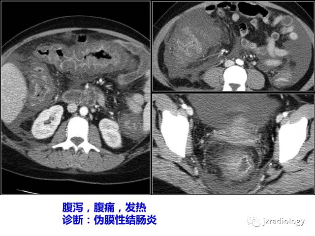 【PPT】肠壁增厚的CT鉴别诊断