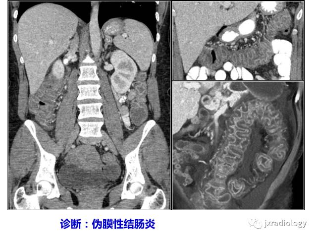【PPT】肠壁增厚的CT鉴别诊断