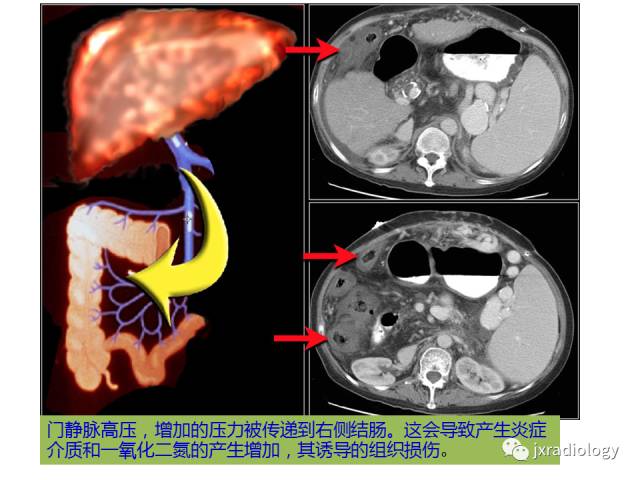 【PPT】肠壁增厚的CT鉴别诊断