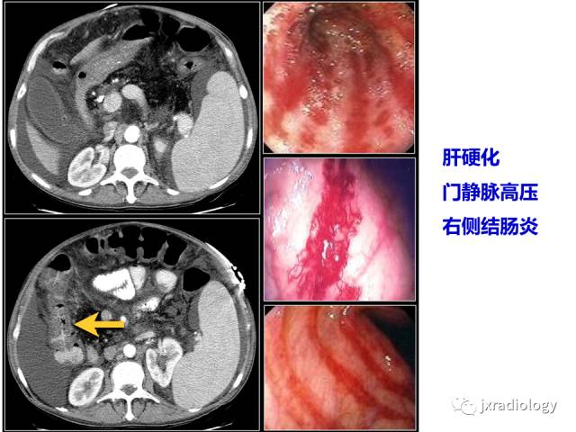 【PPT】肠壁增厚的CT鉴别诊断