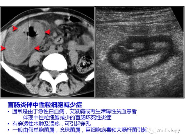 【PPT】肠壁增厚的CT鉴别诊断