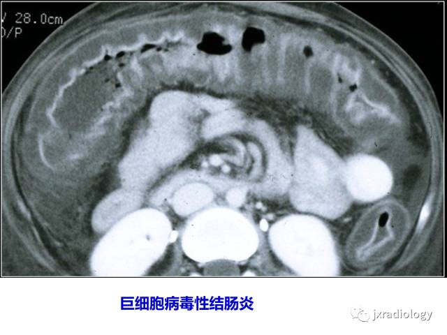【PPT】肠壁增厚的CT鉴别诊断