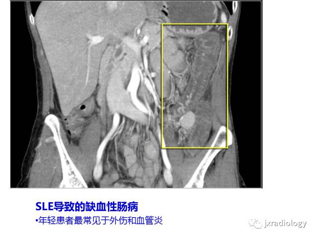 【PPT】肠壁增厚的CT鉴别诊断