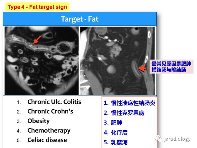【PPT】肠壁增厚的CT鉴别诊断