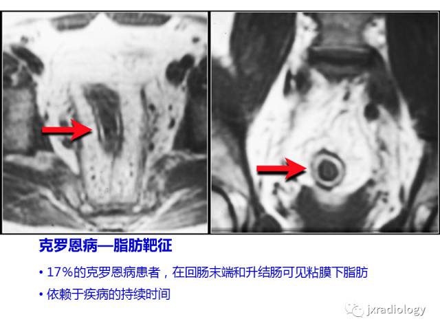 【PPT】肠壁增厚的CT鉴别诊断