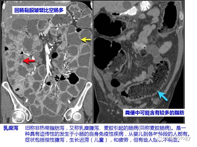 【PPT】肠壁增厚的CT鉴别诊断
