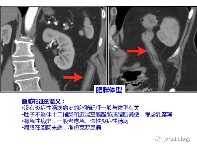 【PPT】肠壁增厚的CT鉴别诊断