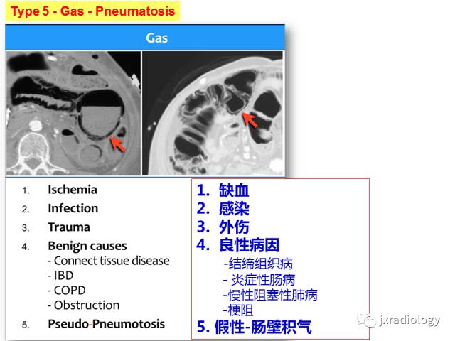 【PPT】肠壁增厚的CT鉴别诊断