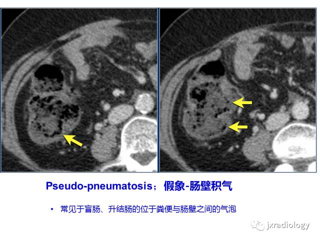 【PPT】肠壁增厚的CT鉴别诊断