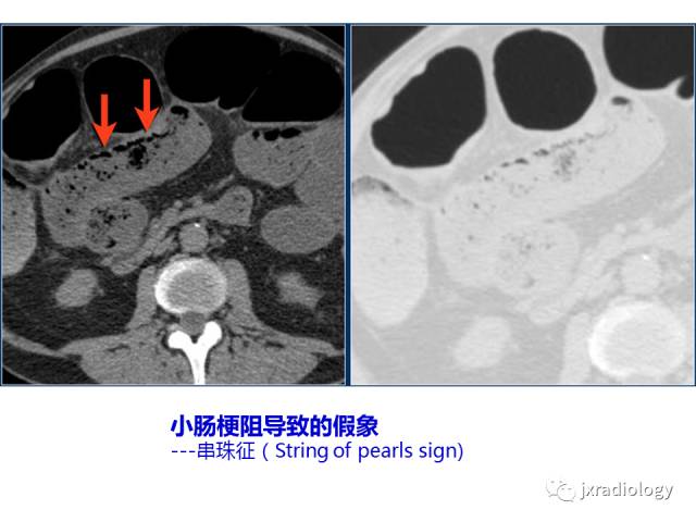 【PPT】肠壁增厚的CT鉴别诊断