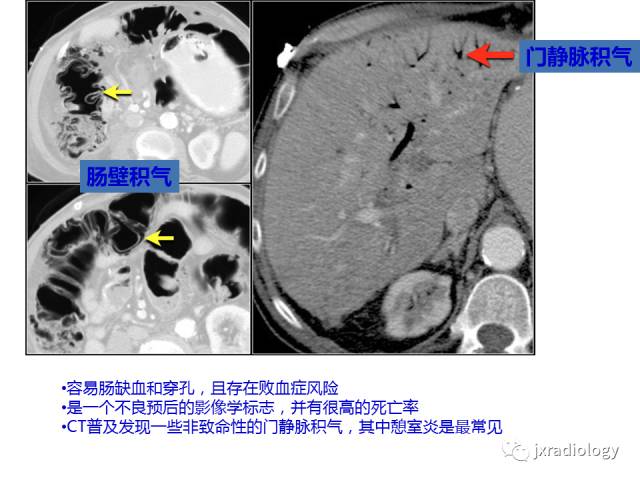 【PPT】肠壁增厚的CT鉴别诊断