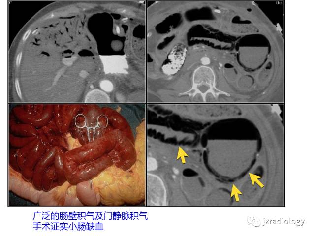 【PPT】肠壁增厚的CT鉴别诊断