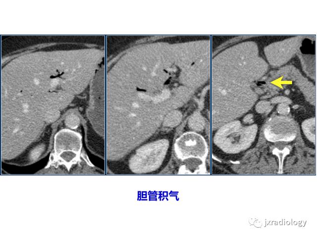 【PPT】肠壁增厚的CT鉴别诊断
