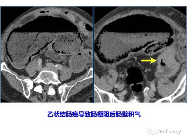 【PPT】肠壁增厚的CT鉴别诊断