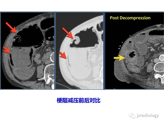 【PPT】肠壁增厚的CT鉴别诊断