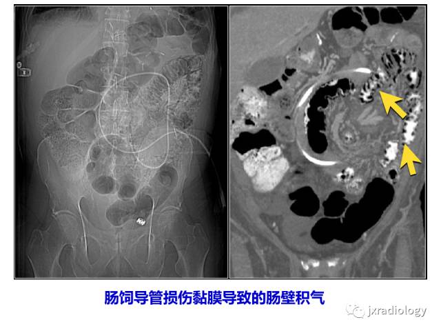 【PPT】肠壁增厚的CT鉴别诊断