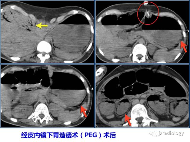 【PPT】肠壁增厚的CT鉴别诊断