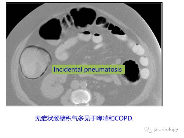 【PPT】肠壁增厚的CT鉴别诊断