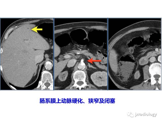 【PPT】肠壁增厚的CT鉴别诊断