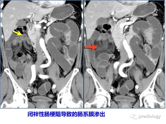 【PPT】肠壁增厚的CT鉴别诊断