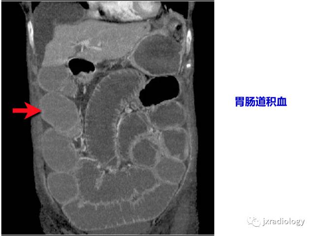 【PPT】肠壁增厚的CT鉴别诊断