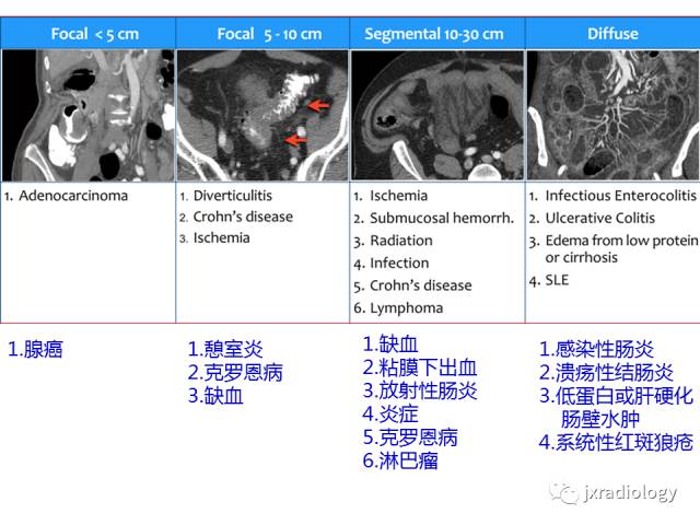 【PPT】肠壁增厚的CT鉴别诊断