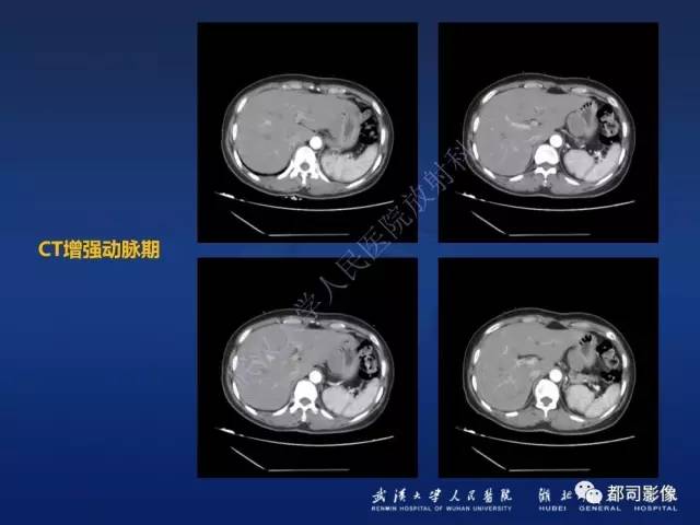 【PPT】胃神经鞘瘤影像诊断