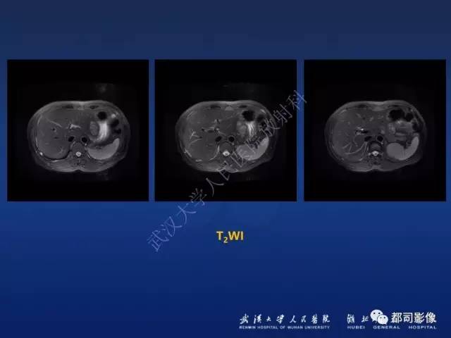 【PPT】胃神经鞘瘤影像诊断