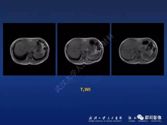 【PPT】胃神经鞘瘤影像诊断