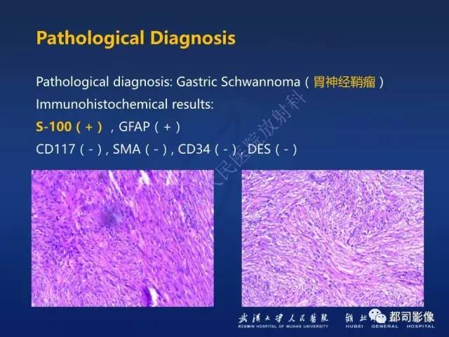 【PPT】胃神经鞘瘤影像诊断