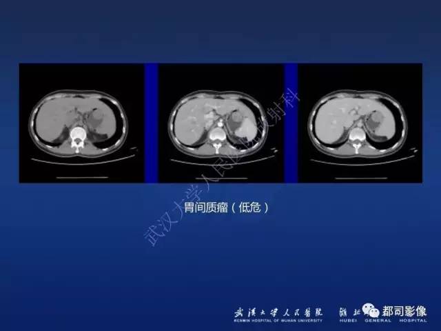 【PPT】胃神经鞘瘤影像诊断