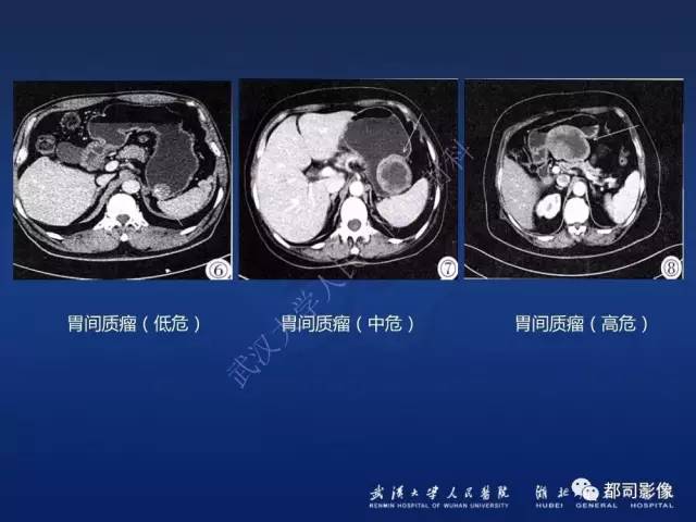 【PPT】胃神经鞘瘤影像诊断