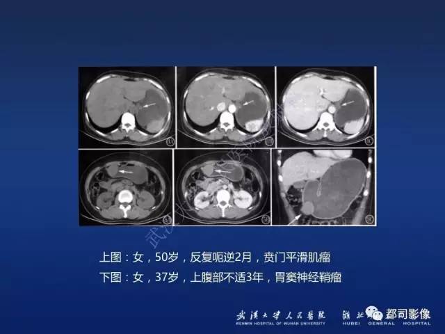 【PPT】胃神经鞘瘤影像诊断