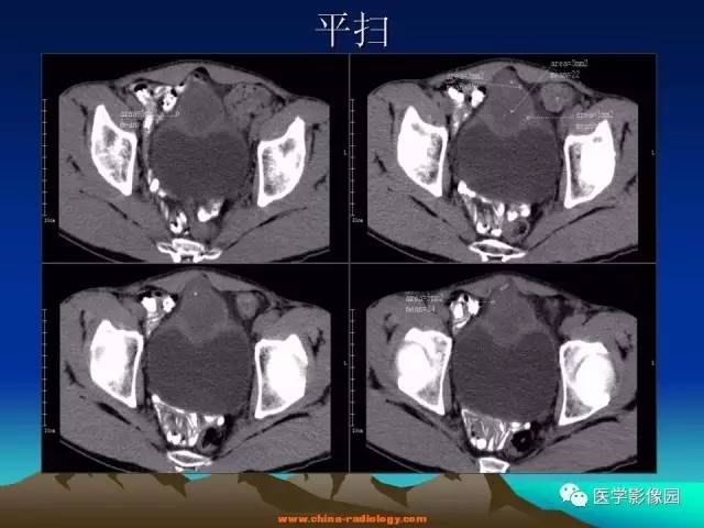 【病例】脐尿管癌伴感染1例CT影像表现