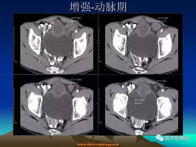 【病例】脐尿管癌伴感染1例CT影像表现