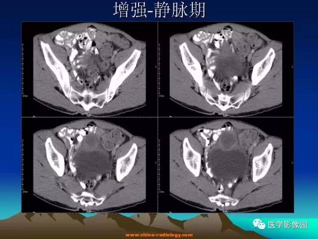 【病例】脐尿管癌伴感染1例CT影像表现
