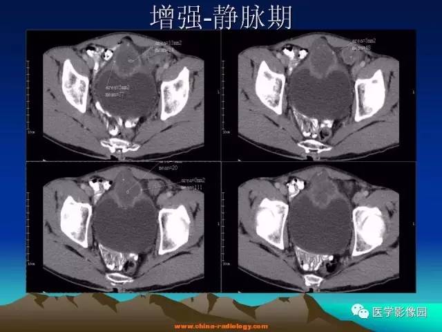 【病例】脐尿管癌伴感染1例CT影像表现
