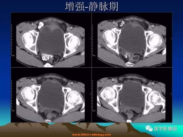 【病例】脐尿管癌伴感染1例CT影像表现