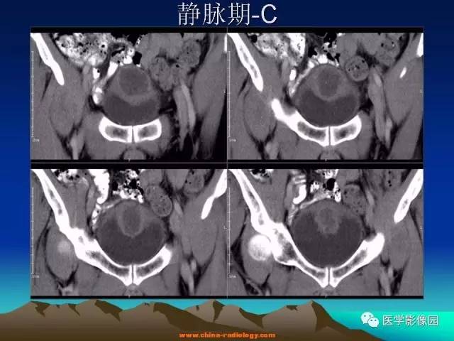 【病例】脐尿管癌伴感染1例CT影像表现