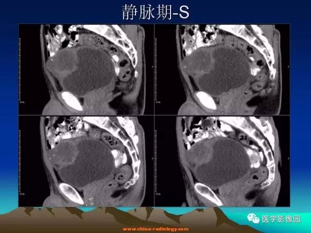 【病例】脐尿管癌伴感染1例CT影像表现