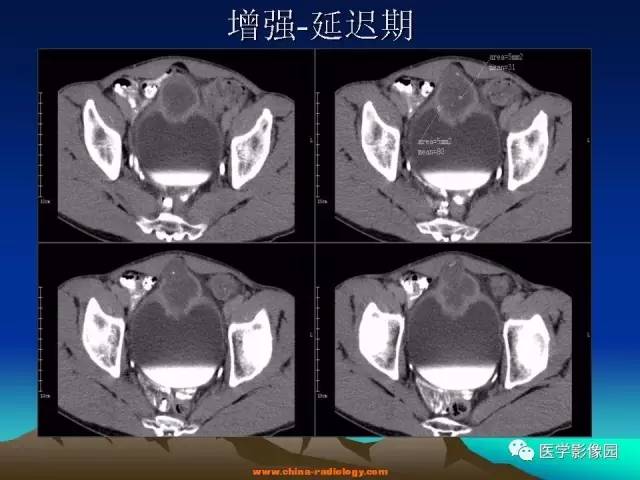 【病例】脐尿管癌伴感染1例CT影像表现