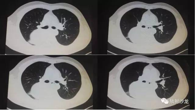 【病例】肺硬化性血管瘤1例CT影像讨论 【病例】肺硬化性血管瘤1例CT影像讨论